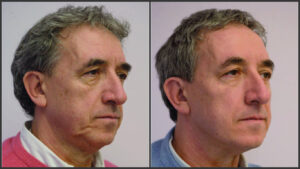 لیفت صورت بدون جراحی